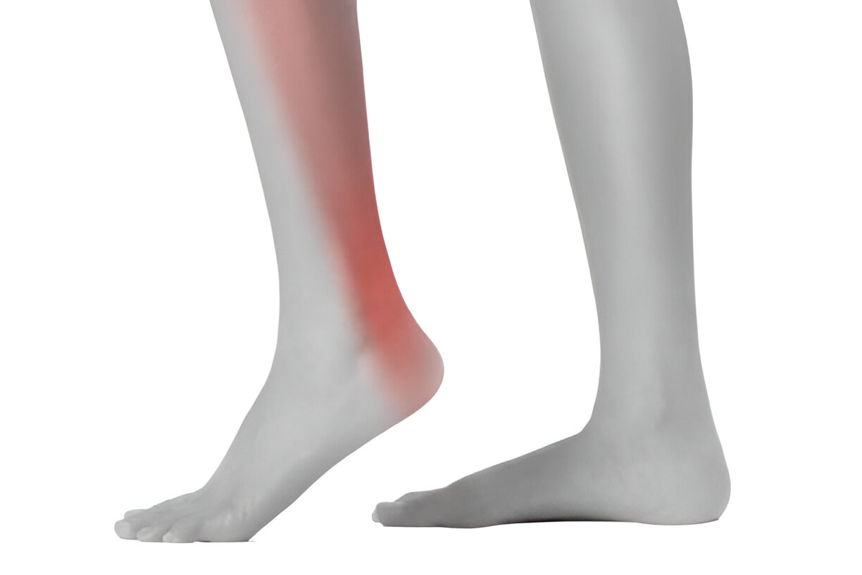 Achilles Tendonitis - Achilles Foot Clinic