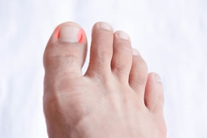 Causes and Treatments for an Ingrown Toenail