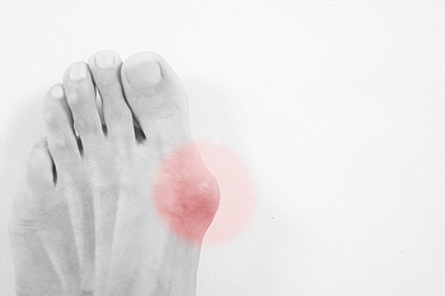 Bunion Misdiagnosis: Health Problems You Can Mistake for Bunions