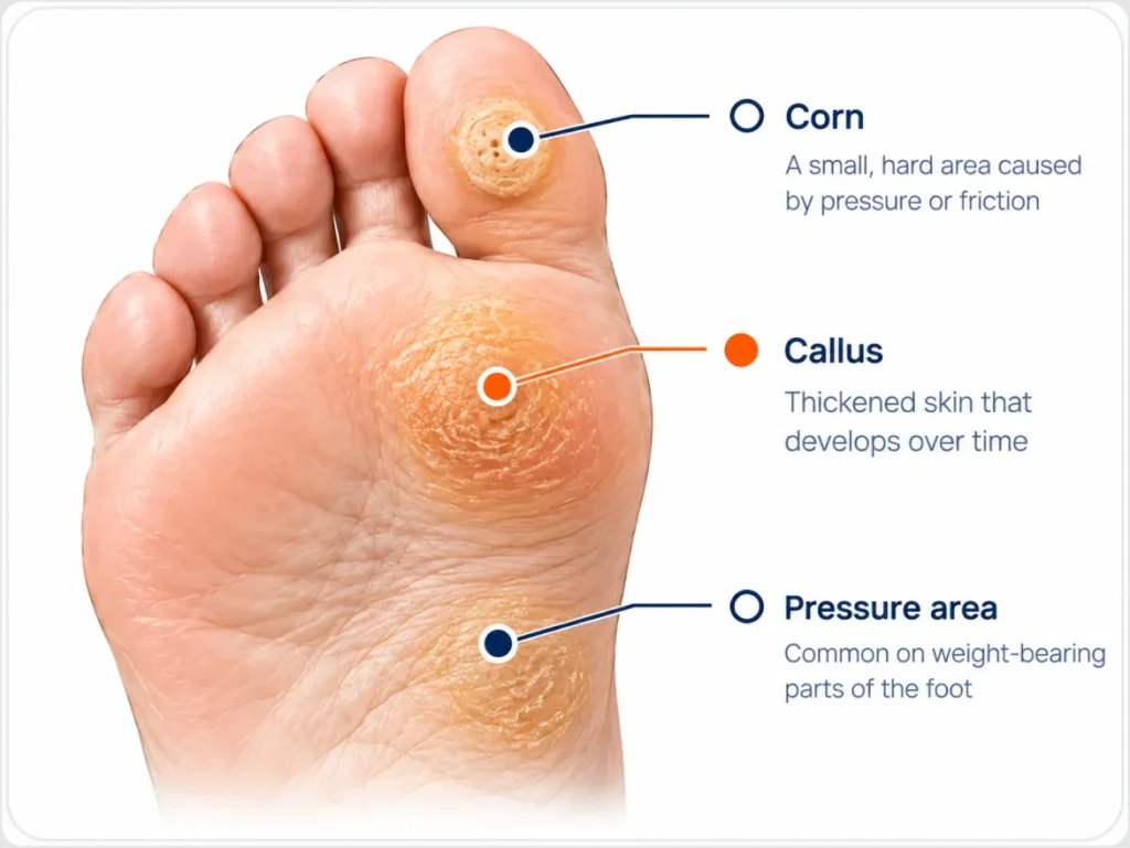 Corn & Callus Removal in Calgary at Achilles Foot Clinic