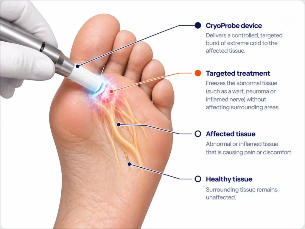 CryoProbe Treatment in Calgary at Achilles Foot Clinic