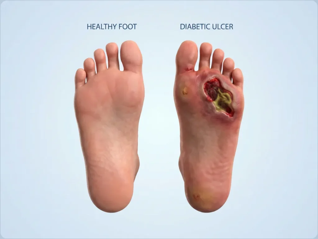 Diabetic Foot Care in Calgary at Achilles Foot Clinic